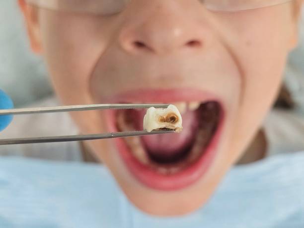 Best Broken or Cracked Tooth Emergency Dentist in New City, NY